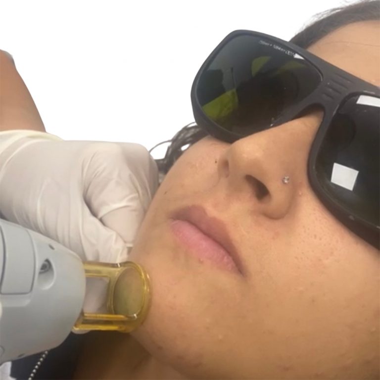 Laser Hair Removal / Chin Laser Hair Removal Orlando Florida Vellisimo