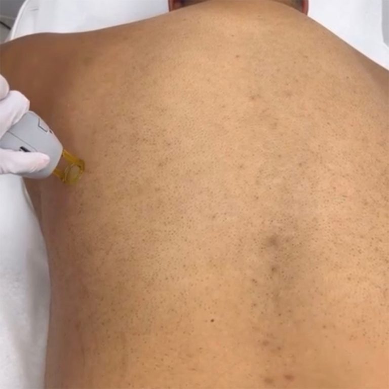 Laser Hair Removal Laser Hair Removal Orlando Florida Vellisimo